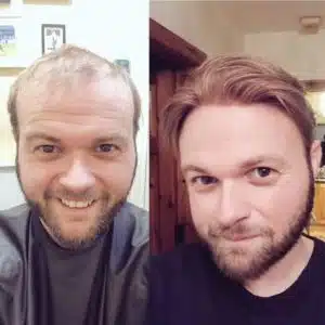 Hair replacement Before and After photo