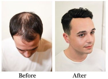 Hair Replacement System