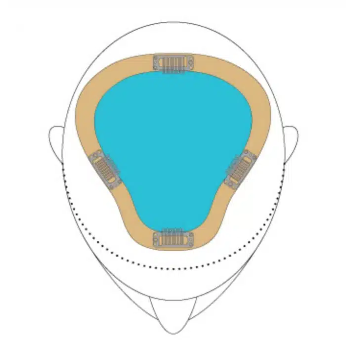 easiPart XL Placement