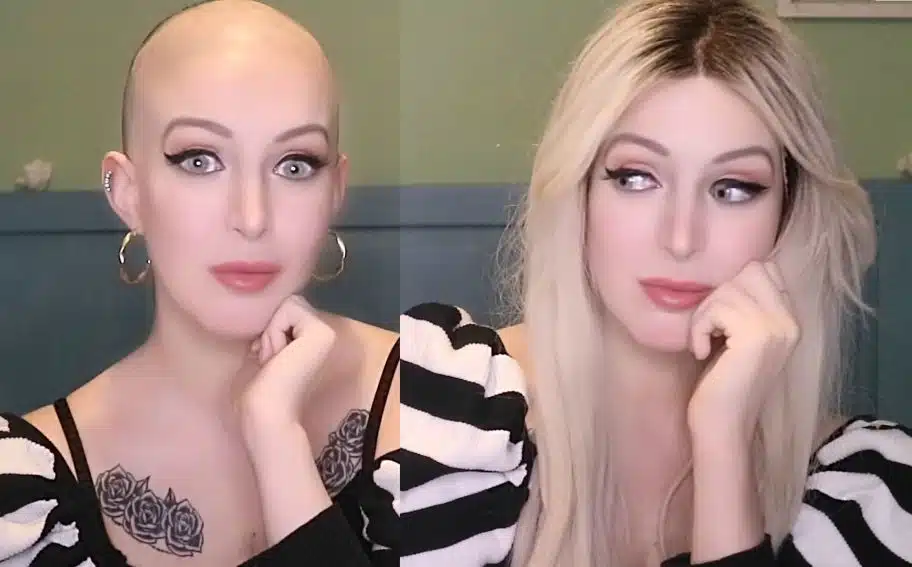 Yolanda's Alopecia Hair Loss Journey